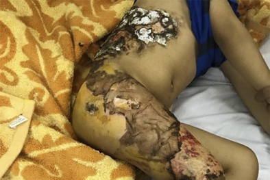 Bé 4 tuổi hoại tử da vì cha mẹ tự chữa bỏng tại nhà, làm gì khi bị bỏng?