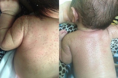 Trẻ dễ nhiễm khuẩn, ngộ độc qua da vì mẹ tự cạo lông tơ cho con