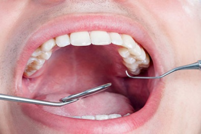 Sống không lành mạnh dễ ung thư miệng