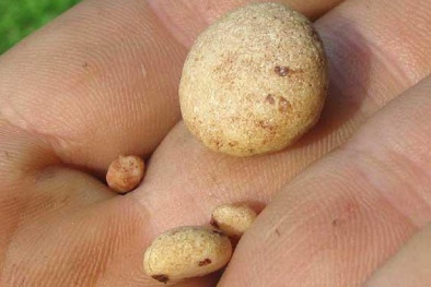 Sỏi thận từ những thói quen ăn uống mà người Việt thường xuyên mắc phải