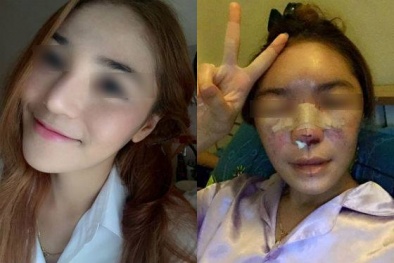 Đột quỵ, mù mắt vì tiêm chất làm đầy nâng mũi