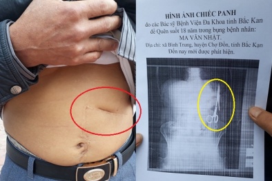 Xác nhận bác sĩ quên kéo trong bụng bệnh nhân 18 năm là có thật
