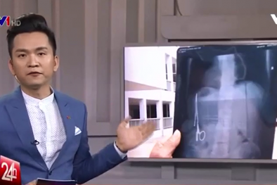 Vụ quên kéo trong bụng bệnh nhân 18 năm: Mời chuyên gia về mổ lại