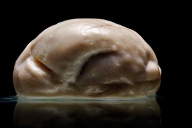 Phát hiện người không có não vẫn sống khoẻ mạnh