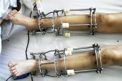 Chịu đau đớn 5 năm để kéo dài chân thêm 10cm