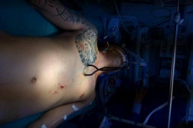Bệnh viện Việt Đức cứu sống nam thanh niên đánh nhau bị 6 vết thương ở tim