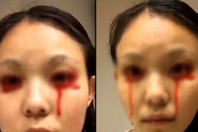 Căn bệnh bí ẩn khiến cô gái bị chảy máu mắt và miệng mỗi ngày