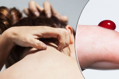 Mẩn ngứa nổi mề đay: Biểu hiện của ung thư máu?