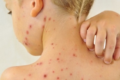 Mắc bệnh thủy đậu: Sai lầm trong ăn uống khiến sẹo lồi lõm