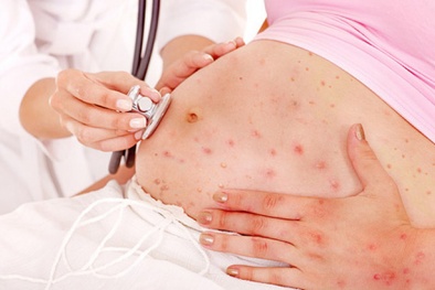 Mắc thủy đậu khi đang mang thai và những nguy hiểm cần biết