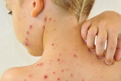 Tin cảnh báo: Bệnh thủy đậu vẫn đang diễn biến phức tạp
