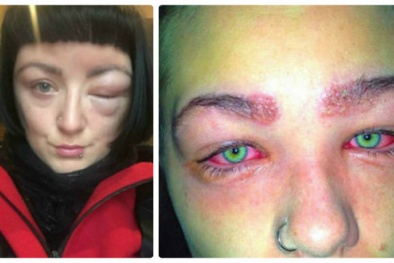 Nguy cơ mù vĩnh viễn vì thói quen tự ý dùng thuốc nhuộm tại nhà