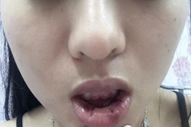 Tiêm filler: Cách làm đẹp đầy hiểm họa