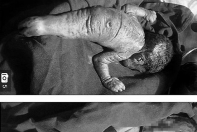 Chứng bệnh kỳ lạ khiến em bé chào đời trong hình hài người cá