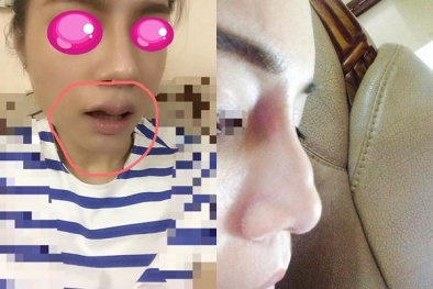 Nếm ‘trái đắng’ khi chọn mặt gửi vàng vào các spa phẫu thuật thẩm mỹ