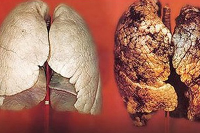 Ung thư phổi: Dấu hiệu nhận biết sớm để phòng nguy hiểm