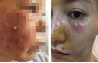 Mặt biến dạng, mũi hoại tử vì tiêm thuốc làm trắng da
