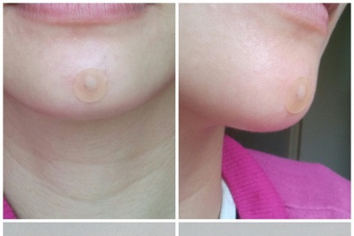 Miếng dán mụn: Nguy cơ kích ứng, phát ban với da nhạy cảm