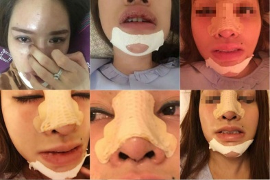 2 phụ nữ hoại tử vì tiêm filler: Hồi chuông cảnh báo đầy sức nặng