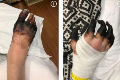 Kinh hoàng người đàn ông phải cắt bỏ tay chân chỉ vì viêm họng cấp tính