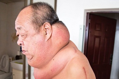 Mang khối u lạ, cổ người đàn ông 'phát phì'
