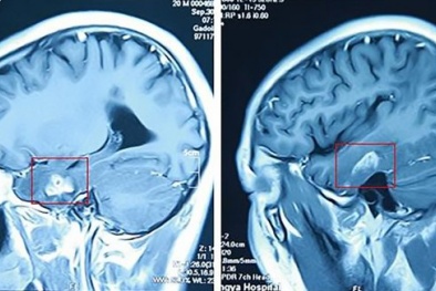 Con sán dài 11 cm sống trong não nam thanh niên sau 1 lần đứt tay