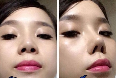 Nâng mũi siêu tốc bằng Serum: 'thần dược' hay trò quảng cáo lố?