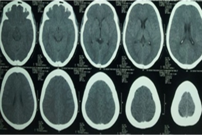Căn bệnh khiến nghệ sĩ Thanh Sang hôn mê nguy hiểm đến mức nào?