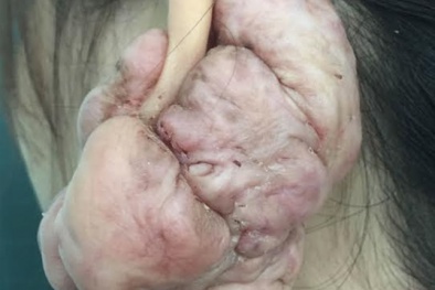 Tai biến dạng vì bấm lỗ tai ở chợ 