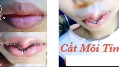 Cẩn trọng với môi sừng trâu du nhập sang Việt Nam dưới hình thức 'môi trái tim'