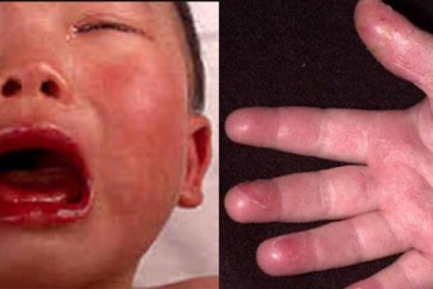 Bệnh mùa hè ở trẻ khiến cả thế giới khiếp sợ vì những biểu hiện quen thuộc mà nguy hiểm