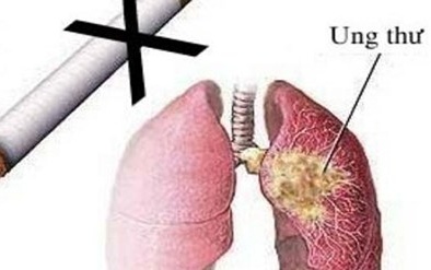 8 bệnh ung thư 'nguy hiểm' do hút thuốc lá