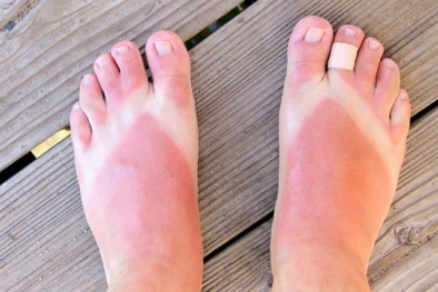 Cháy nắng sau khi đi biển, cần làm gì để cải thiện da?