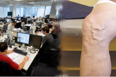 Cẩn trọng với chứng suy giãn tĩnh mạch ở dân văn phòng gây phù chân, đột tử