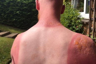 Bỏng nắng nguy hiểm hơn chúng ta tưởng