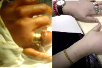 Hoại tử phải cắt ngón tay chỉ vì cách đeo nhẫn không đúng kiểu 