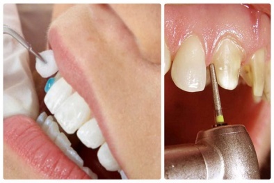 Bọc răng sứ - Đau đớn và những hiểm nguy chết người