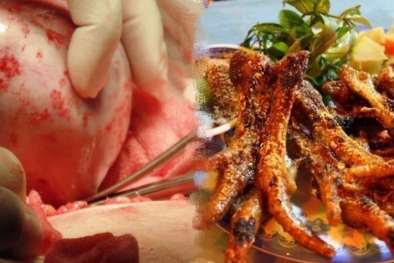 Nếu không muốn bị u nang buồng trứng, chị em nên lập tức tránh xa món 'khoái khẩu' này