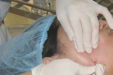 Dùng kim nặn mụn có nguy cơ lây nhiễm HIV, viêm gan siêu vi