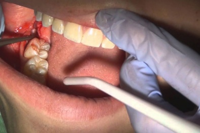 Bí ẩn những chiếc răng bất ngờ nổ tung rồi vỡ vụn trong miệng người