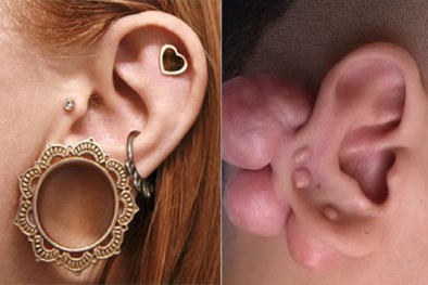 Nhiễm HIV, điếc vĩnh viễn vì... nong tai