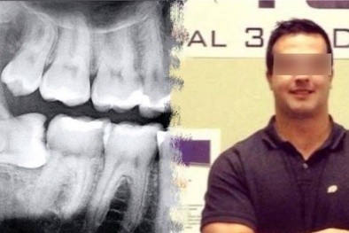 Chuyên gia tiết lộ sự thật kinh hoàng: Tử vong vì chiếc răng khôn, chớ coi thường