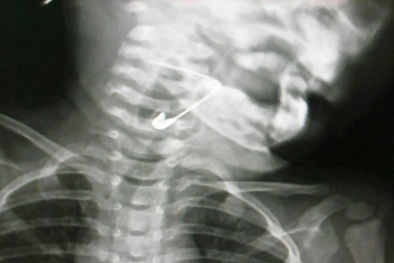 Chơi đùa cùng người thân, bé gái vô tình nuốt phải kim băng