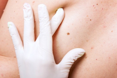 Những dấu hiệu bất thường của nốt ruồi cảnh báo bệnh ung thư da