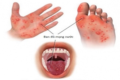Bệnh tay chân miệng diễn biến rất nhanh có thể gây biến chứng tử vong
