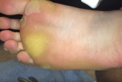 Đừng coi thường vết chai chân vì nó có thể đang cảnh báo bệnh nguy hiểm!