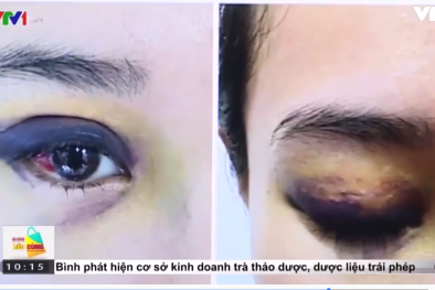 'Nhấn mí mắt, lúc khâu bị đứt chỉ nên để lại kim luôn trong mí mắt'