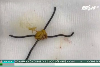 Nam thanh niêm bị thủng 5 lỗ ruột non do nuốt chửng 2 cọng kẽm