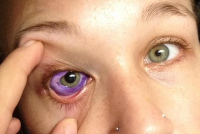 Xăm lòng trắng mắt: Trào lưu nguy hiểm