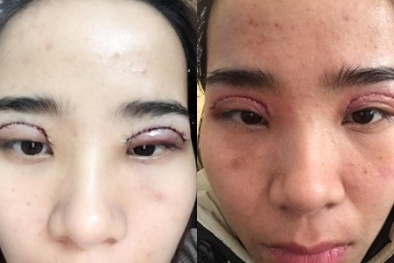 Nhiễm trùng mắt nặng, khô giác mạc do... nhấn mí